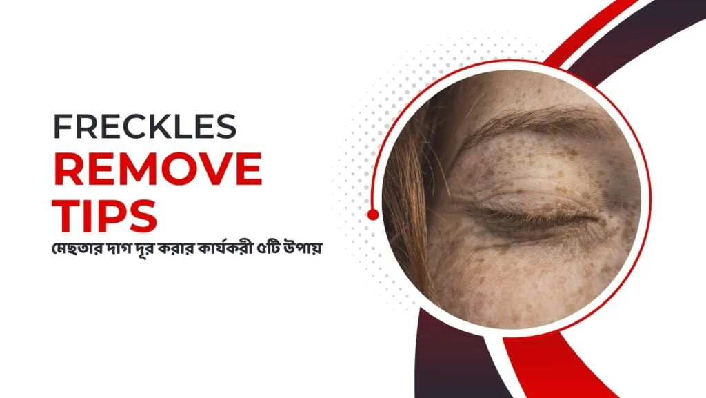 Easy Freckles Remove Solutions 2025 | মেছতা দূর করার Latest কার্যকরী Tips 1 Freckles Remove Tips