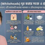 Natural Guide to Removing Whiteheads